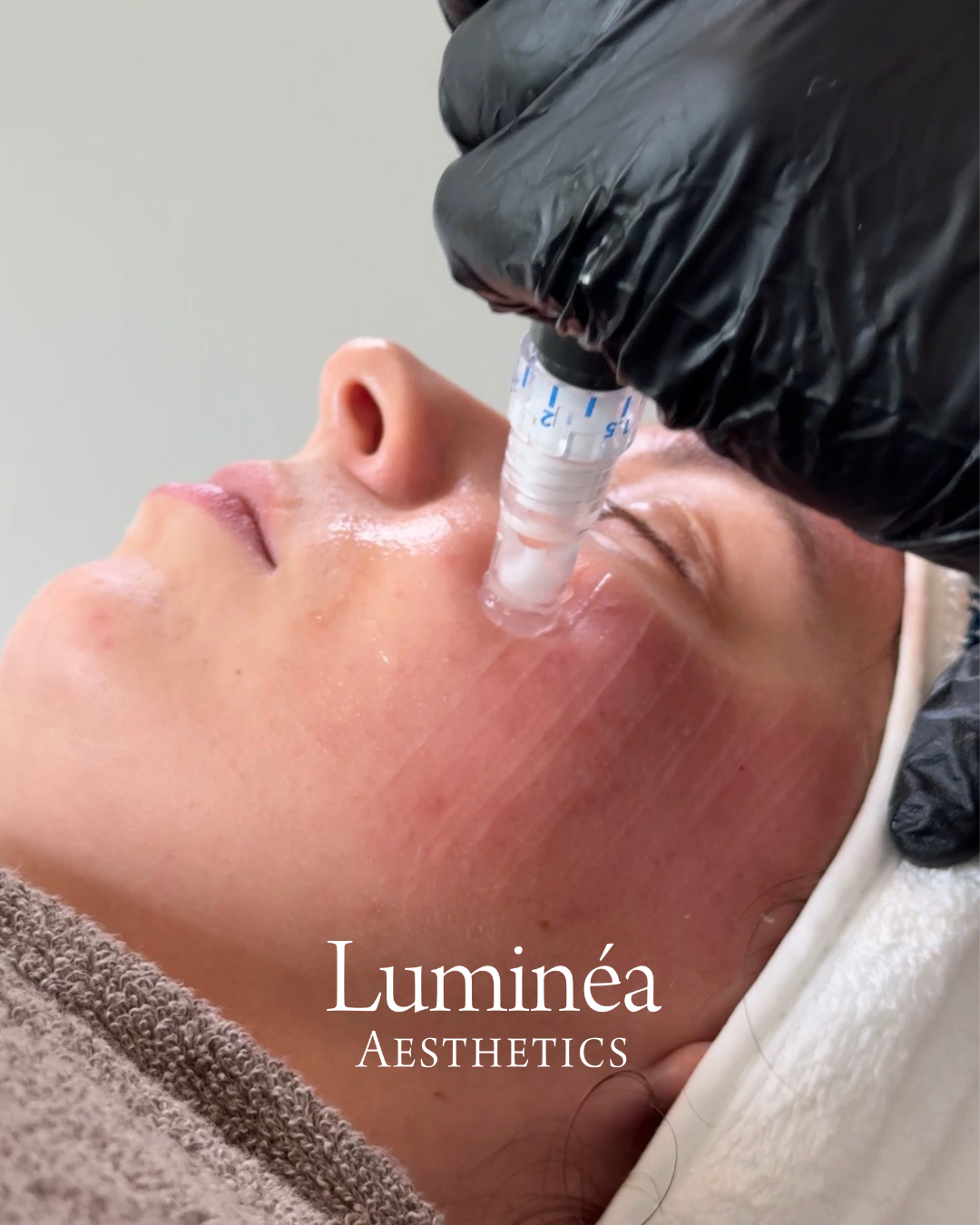 Microneedling – Behandlungsmoment